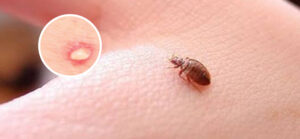 Bed Bugs Pest Control Dubai